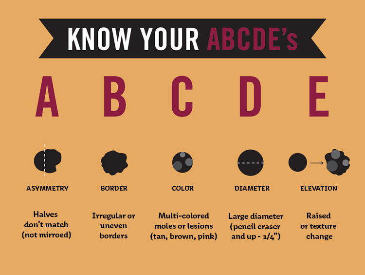 Know the ABCDEs of Skin Changes - Asymmetry, Border, Color, Diameter, Elevation